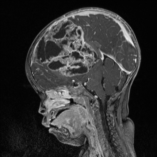 Embryonal tumor with multilayered rosettes (ETMR) | Image | Radiopaedia.org