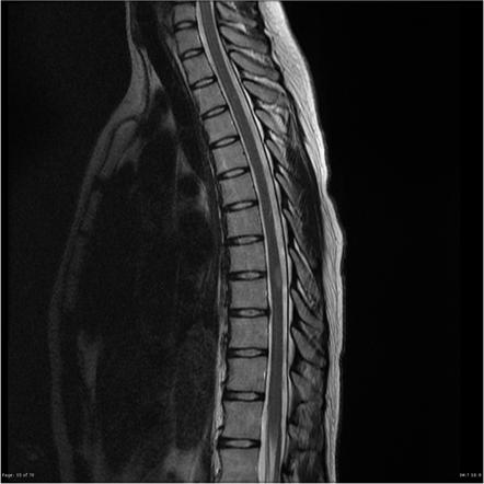 Medulloblastoma | Image | Radiopaedia.org