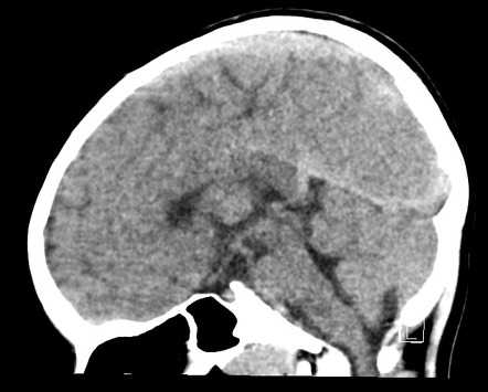 cerebellar stroke case study