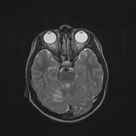 cerebellar stroke case study