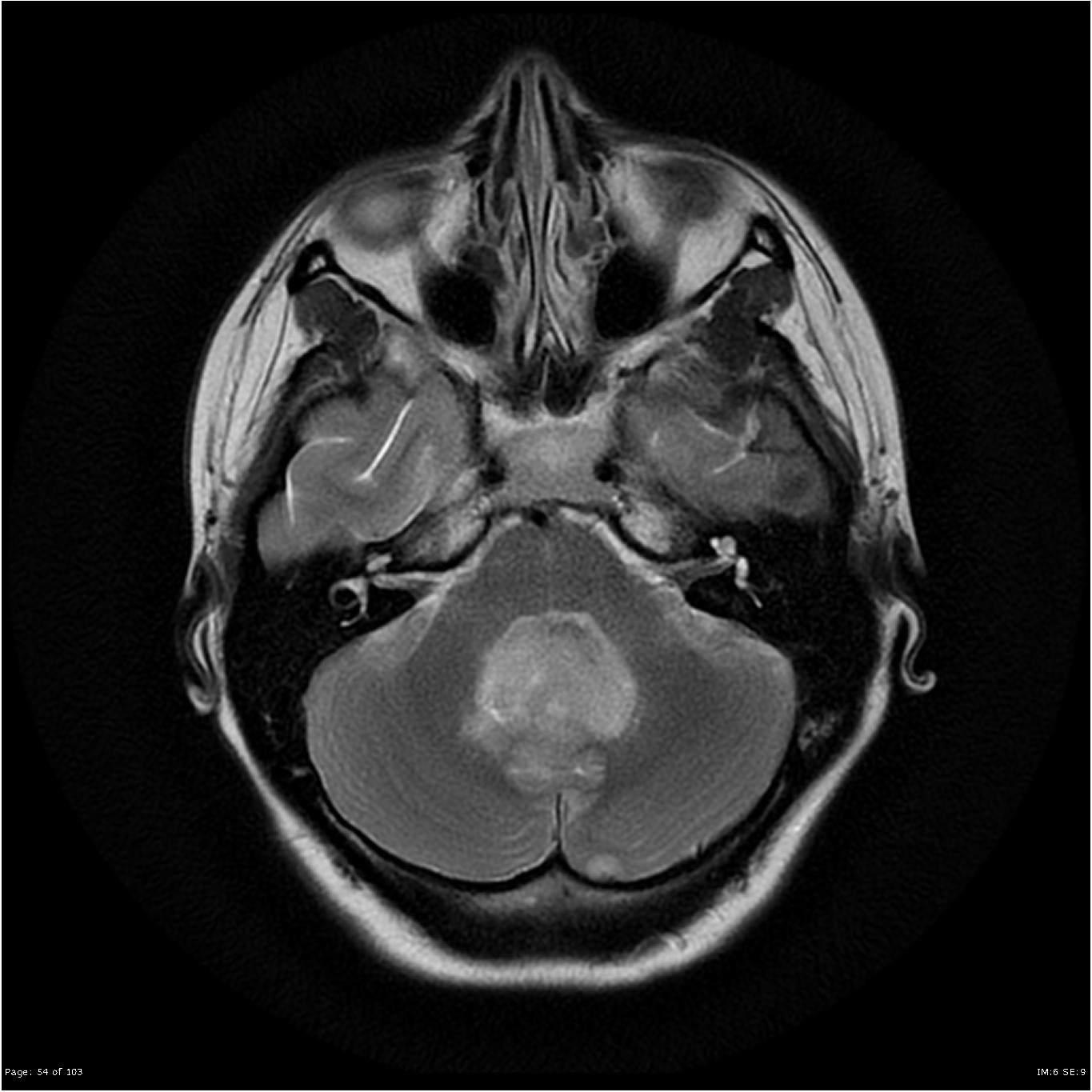 qarc medulloblastoma