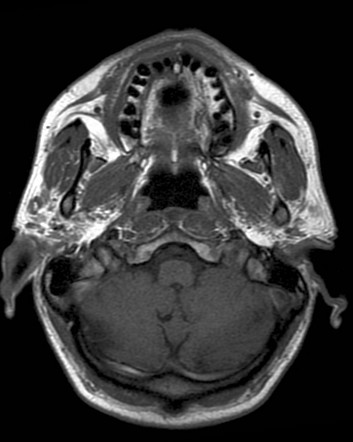 Thornwaldt cyst | Radiology Case | Radiopaedia.org