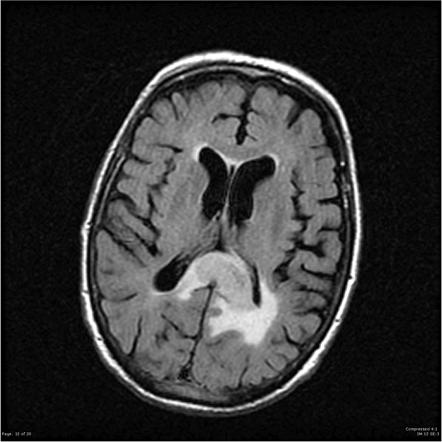 Glioblastoma, IDH-wildtype | Radiology Reference Article | Radiopaedia.org