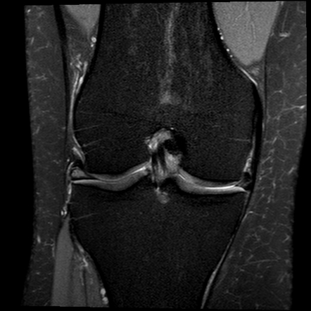 Displaced medial meniscal tear | Image | Radiopaedia.org