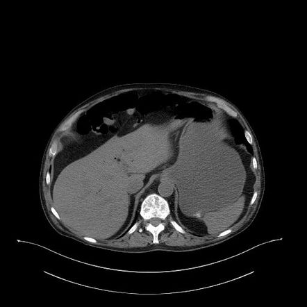 Portal venous gas - benign etiology | Radiology Case | Radiopaedia.org