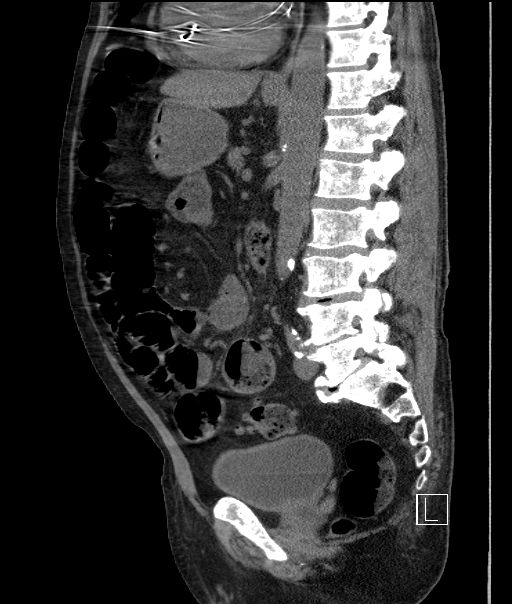 Portal venous gas - benign etiology | Image | Radiopaedia.org