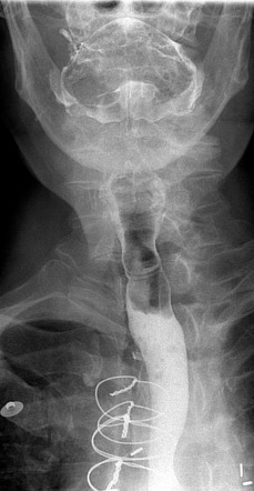 Esophageal Webs And Rings Background Pathophysiology