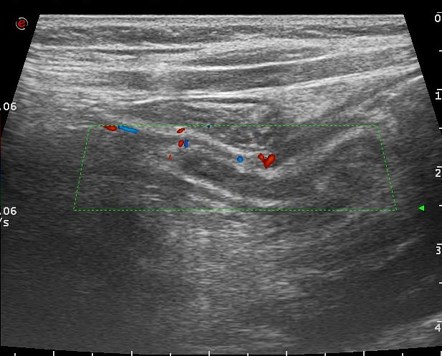 Acute Appendicitis | Radiology Case | Radiopaedia.org