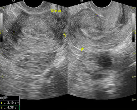 Ectopic pregnancy | Radiology Case | Radiopaedia.org