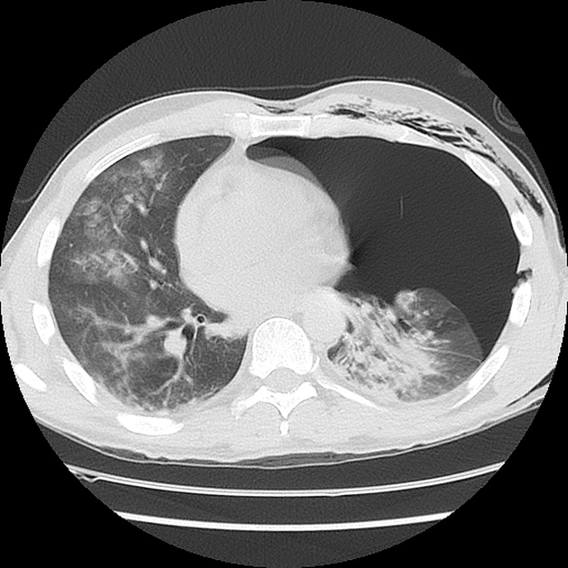 Tension pneumothorax post knife stabbing | Radiology Case 