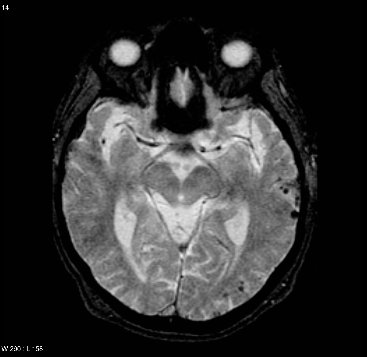 Cerebral Amyloid Angiopathy MRI