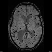 Cerebral Amyloid Angiopathy | Radiology Reference Article | Radiopaedia.org