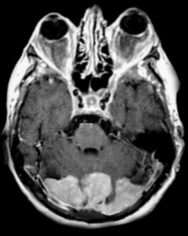 Erdheim-Chester Disease | Image | Radiopaedia.org