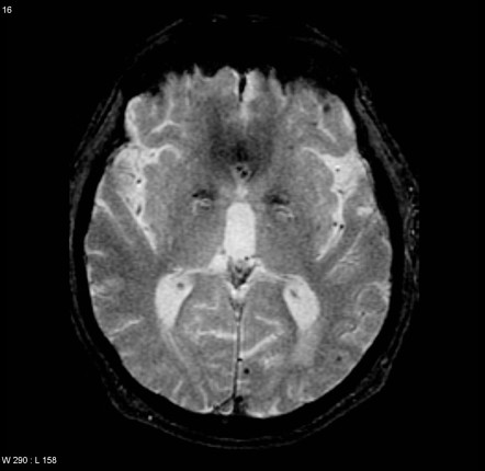 Cerebral Amyloid Angiopathy 