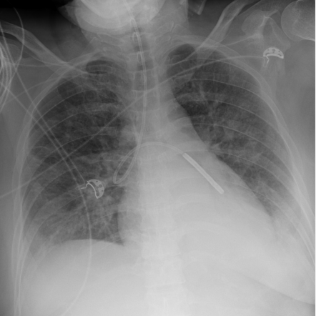 Nasogastric tube positioning | Radiology Reference Article ...