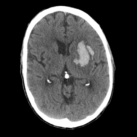 Hypertensive Hemorrhage Ct Hypertensive Hemorrhage Ct Abnormal Ct Head ...