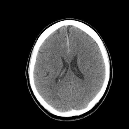 Subdural Hematoma Falx