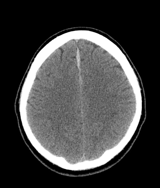 acute subdural hematoma mri