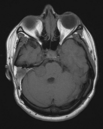 Acoustic schwannoma (recurrent) | Radiology Case | Radiopaedia.org