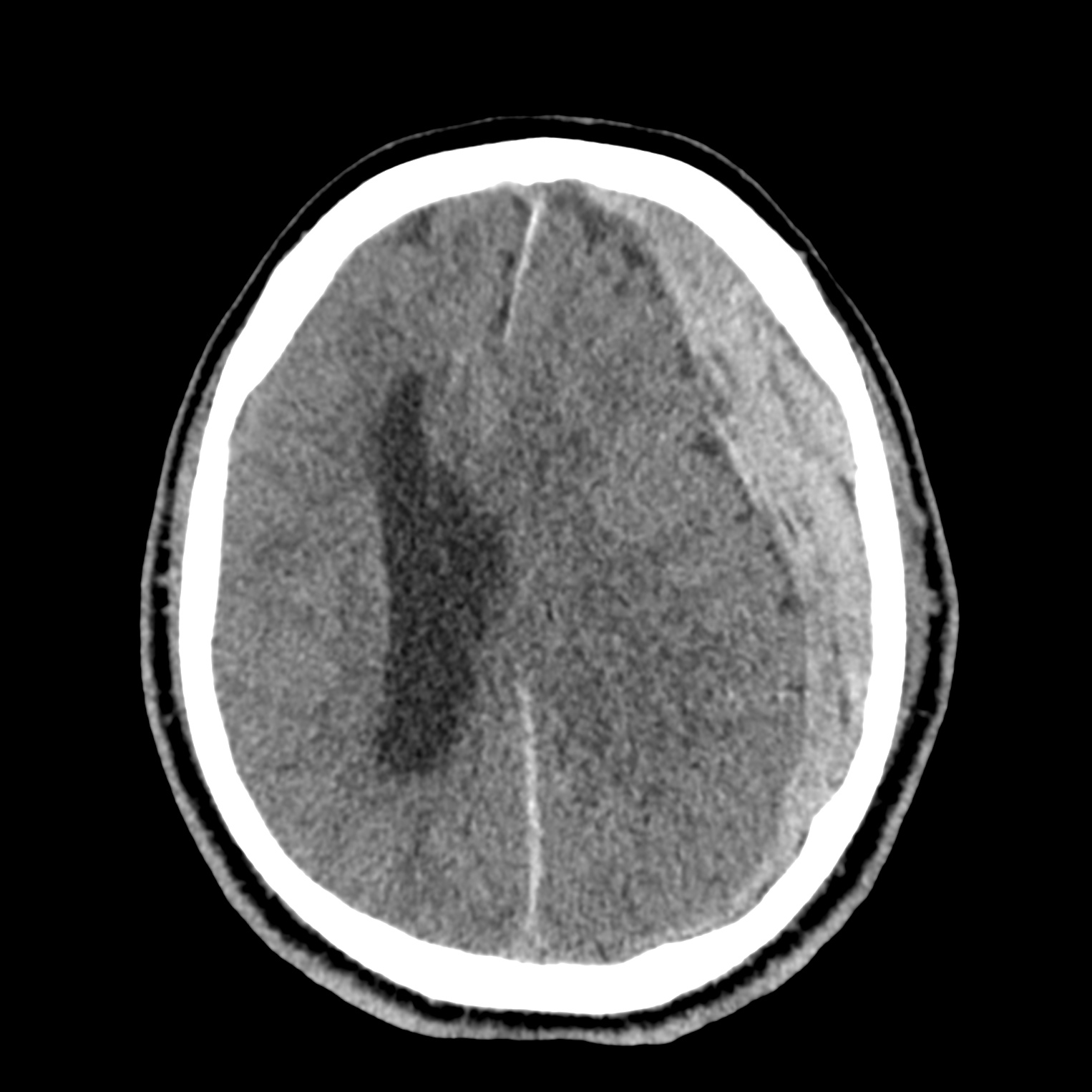 File:Subdural hematoma, uncal herniation and Duret brainstem hemorrhage ...