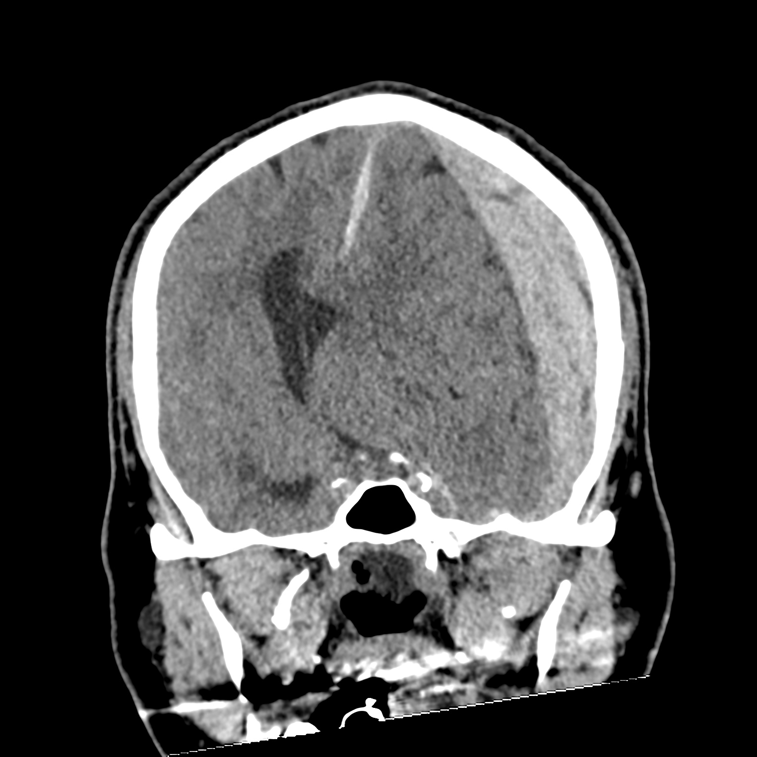 File:Subdural hematoma, uncal herniation and Duret brainstem hemorrhage ...