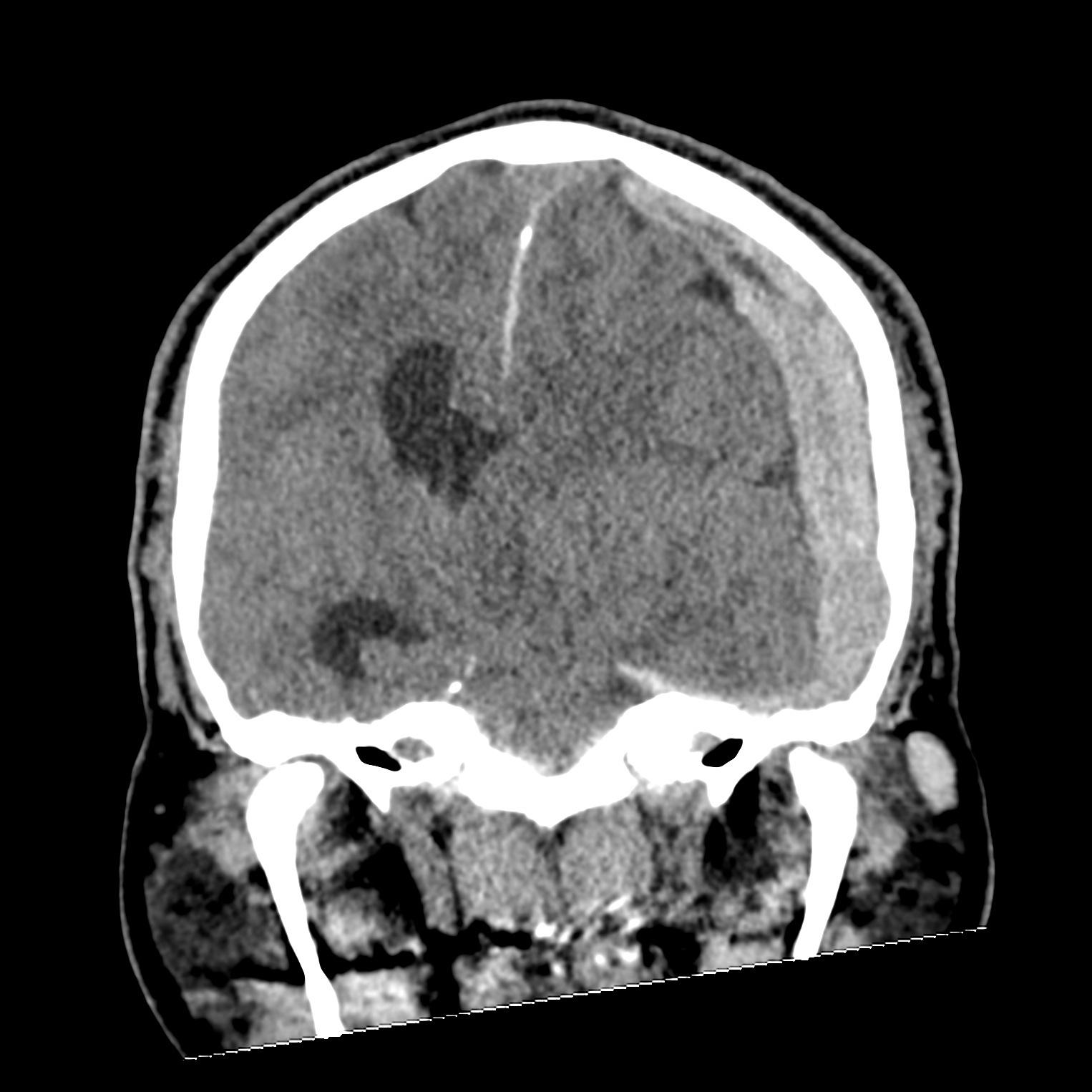 File:Subdural hematoma, uncal herniation and Duret brainstem hemorrhage ...