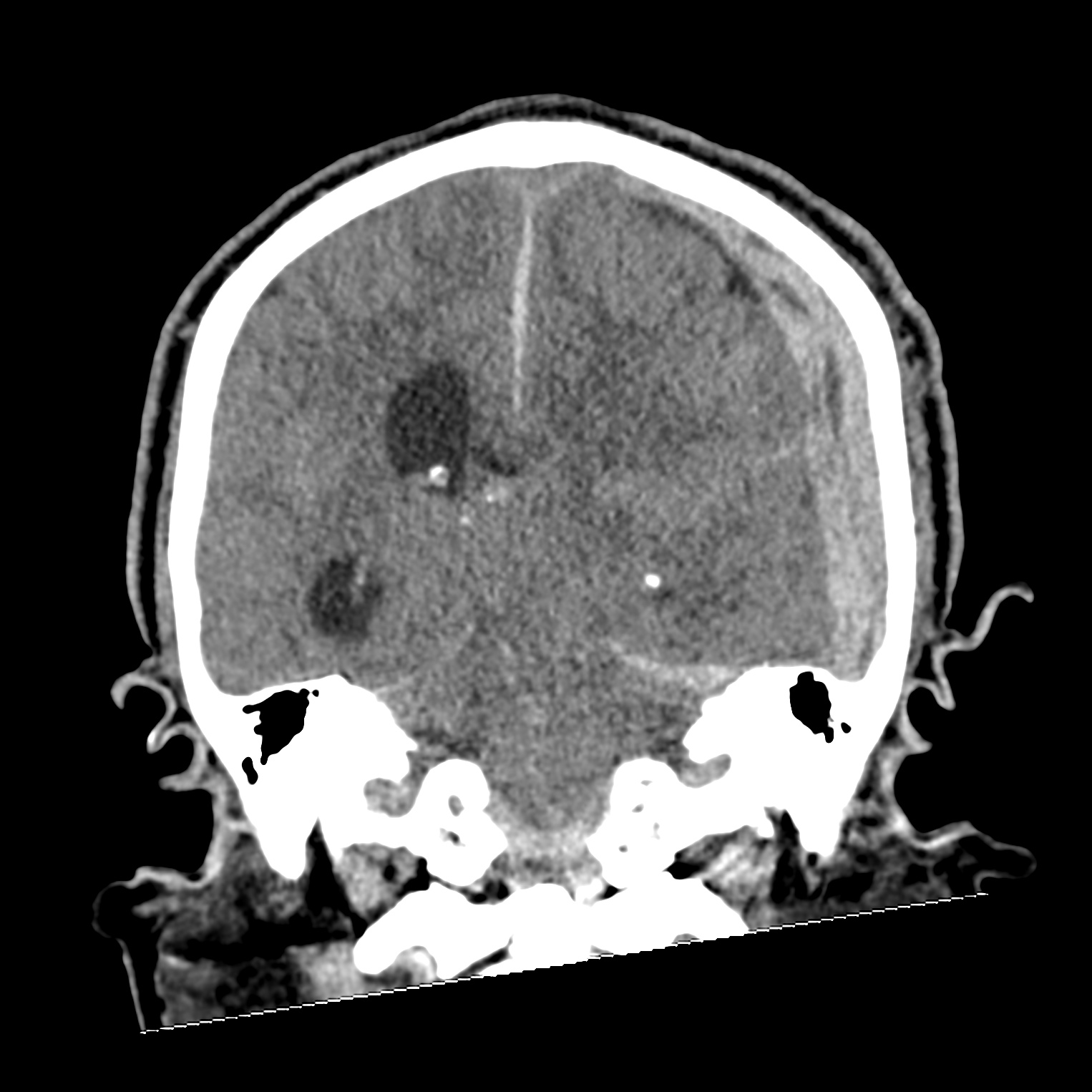 File:Subdural hematoma, uncal herniation and Duret brainstem hemorrhage ...