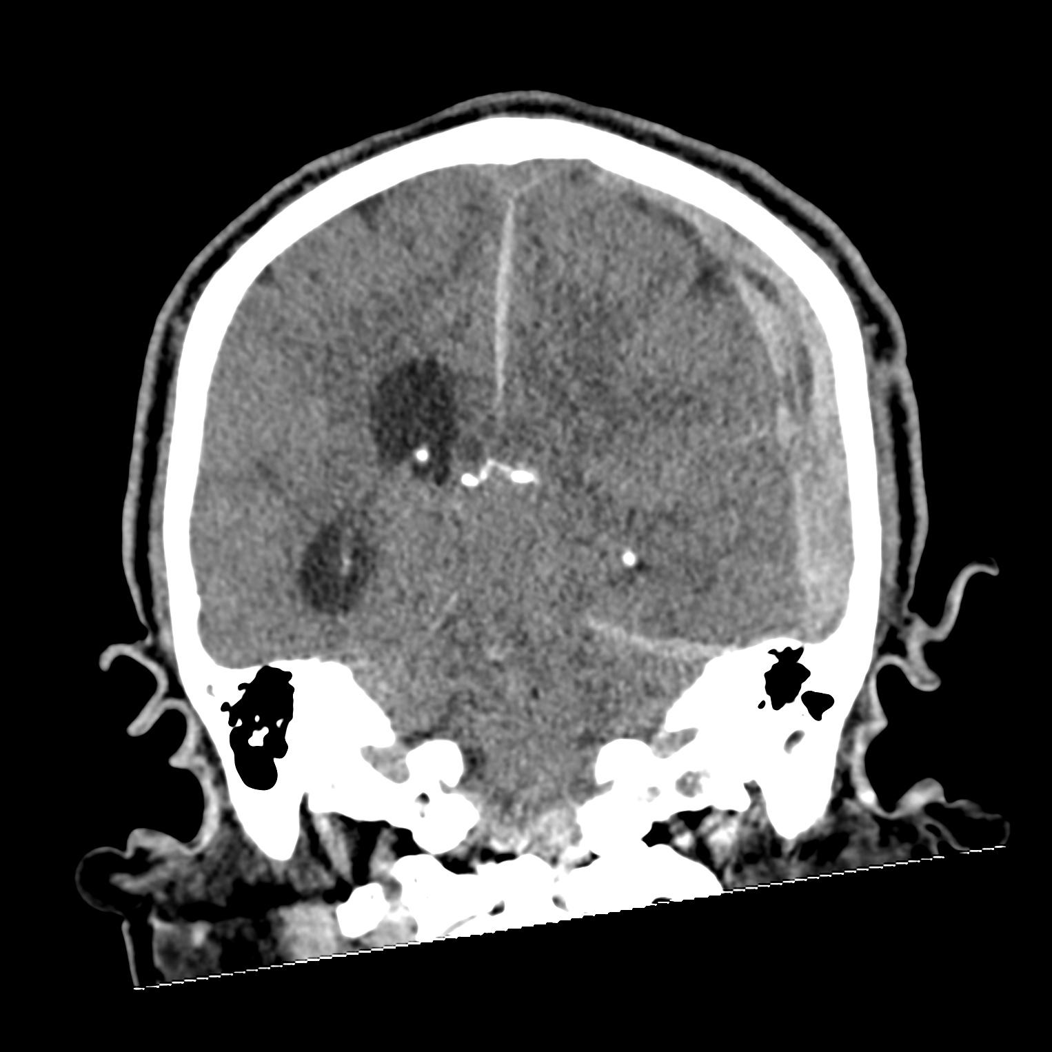 File:Subdural hematoma, uncal herniation and Duret brainstem hemorrhage ...