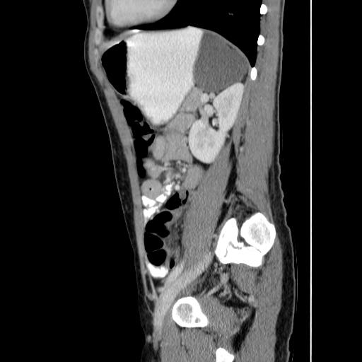 Gastric duplication cyst | Image | Radiopaedia.org