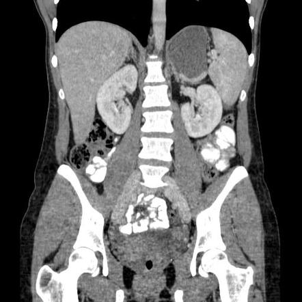 Gastric duplication cyst | Image | Radiopaedia.org