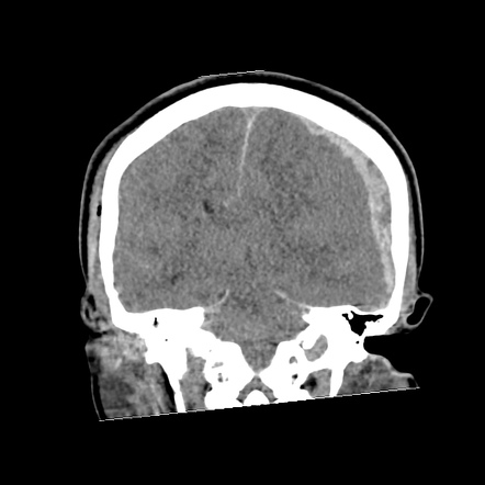 Uncal herniation | Radiology Reference Article | Radiopaedia.org