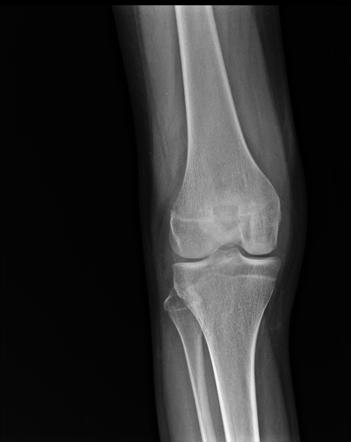 Tuberculous synovitis of knee | Radiology Case | Radiopaedia.org