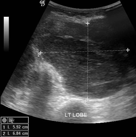 Thyroid lymphoma | Radiology Reference Article | Radiopaedia.org