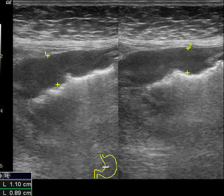 Gastric carcinoma with hepatic metatstasis | Radiology Case ...