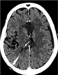 Corpus callosum changes following obstructive hydrocephalus | Image ...