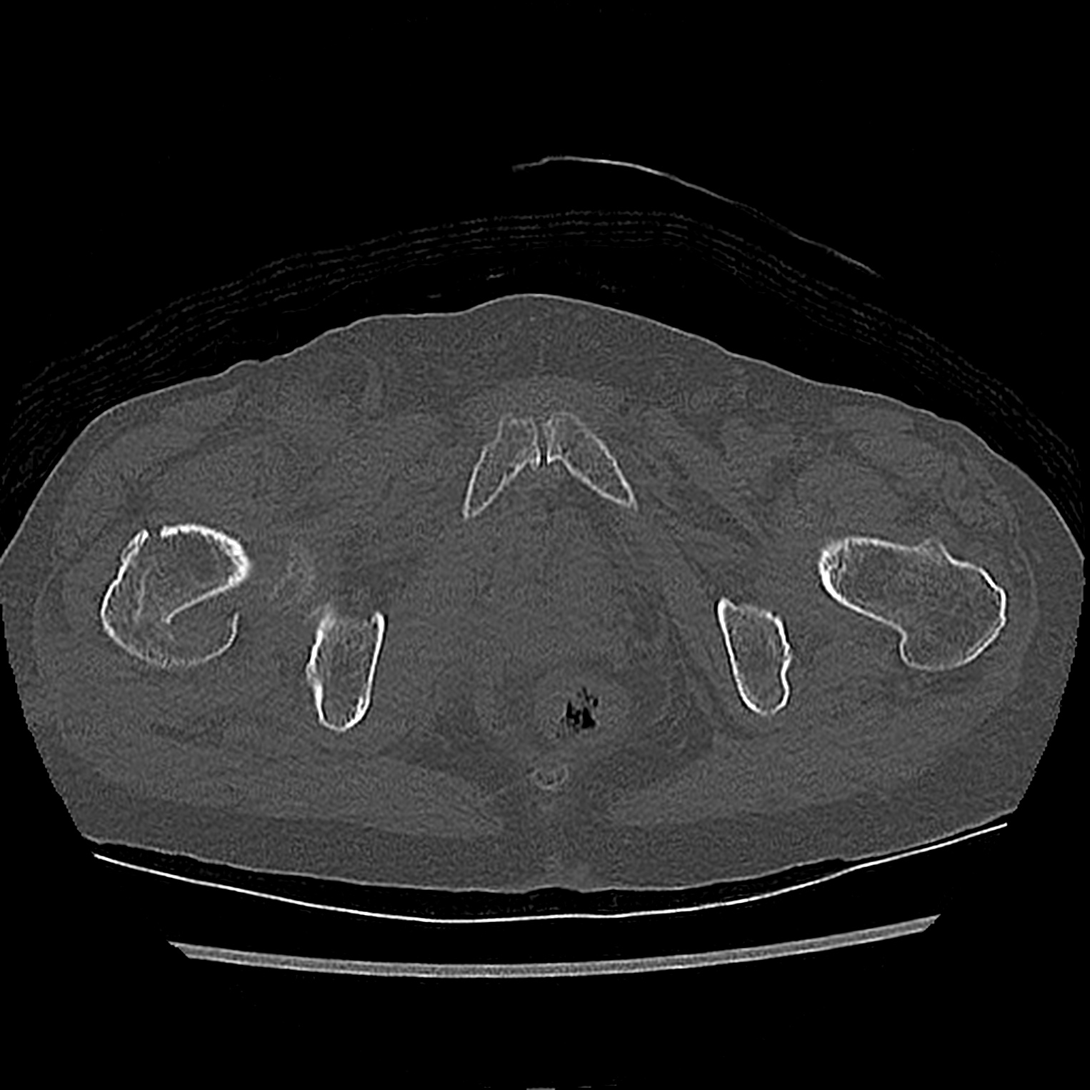 Pelvic bleeding treated with embolization | Image | Radiopaedia.org