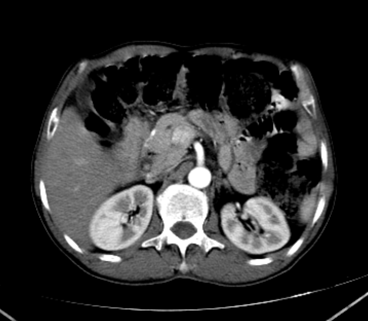 Biliary ascariasis | Image | Radiopaedia.org