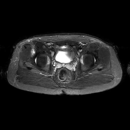 Proximal Rectus Femoris Tendon Tear | Image | Radiopaedia.org