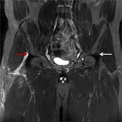 Viewing playlist: Hip cases | Radiopaedia.org