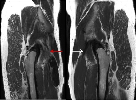 Proximal rectus femoris tendon tear | Image | Radiopaedia.org