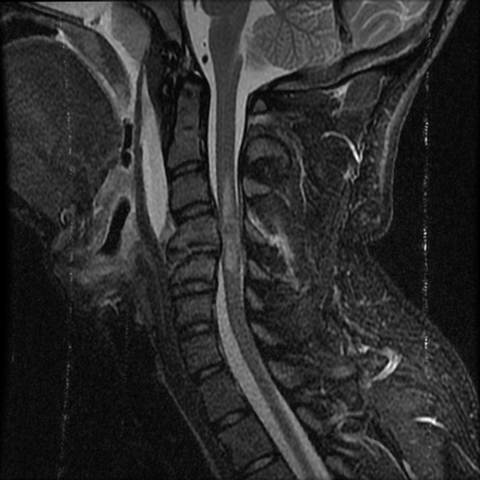 Figure 1 From Spinal Cord Intramedullary Hemorrhage Hematomyelia