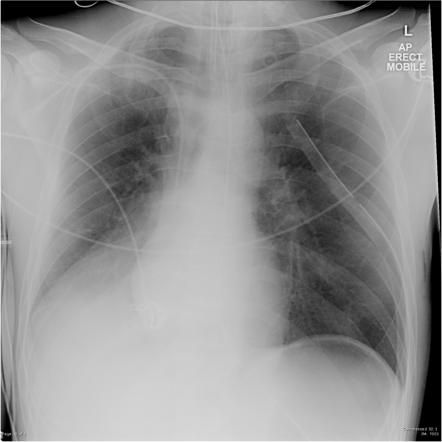 Right lower lobe collapse | Radiology Reference Article | Radiopaedia.org