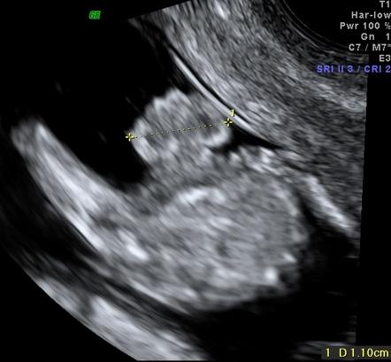 Physiological gut herniation | Radiology Reference Article ...