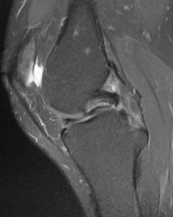 Double PCL sign | Radiology Reference Article | Radiopaedia.org