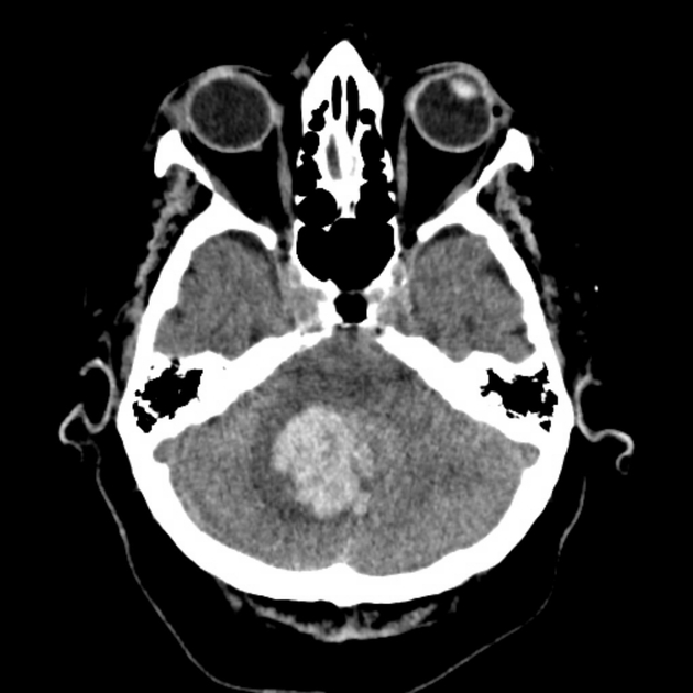 Subarachnoid hemorrhage - Wikipedia