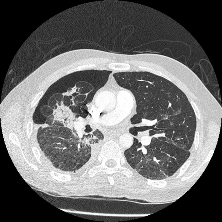 case study lobar pneumonia