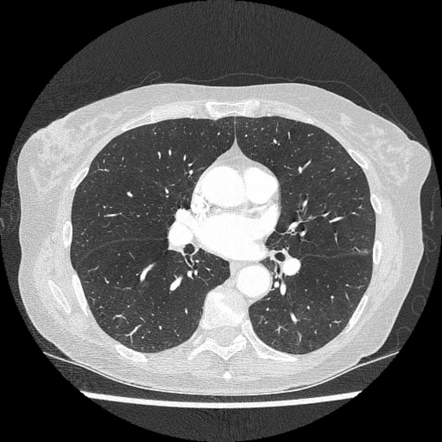 Lung atelectasis | Radiology Reference Article | Radiopaedia.org