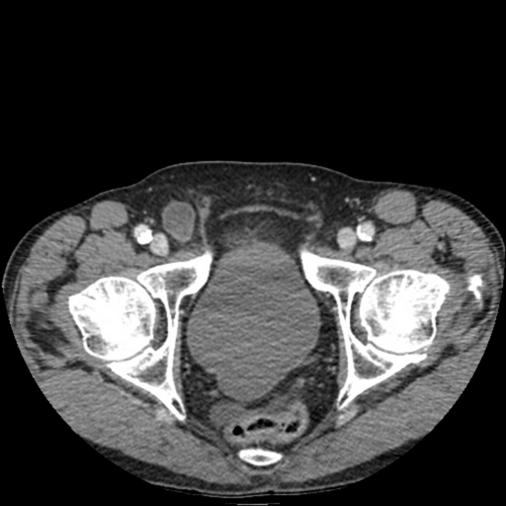 Small Bowel Obstruction Secondary To Femoral Hernia Image