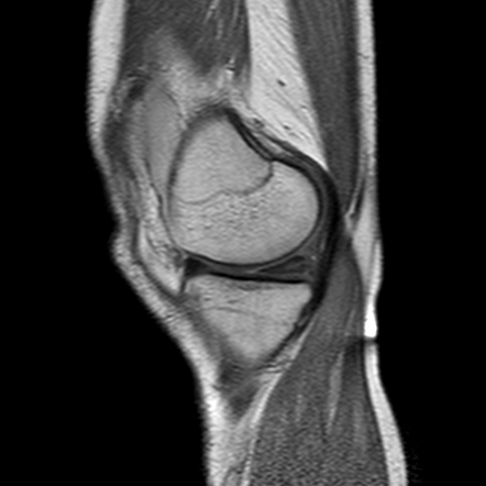 Acute Lateral Patellar Dislocation 