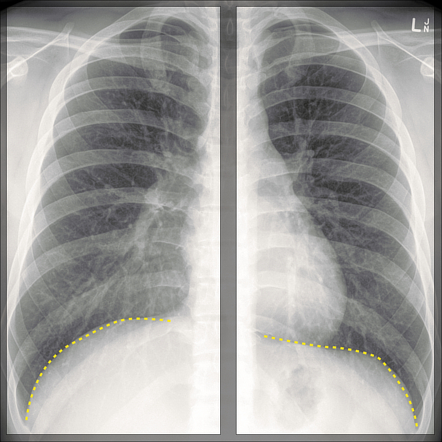 Chest x-ray review: breathing | Radiology Reference Article ...